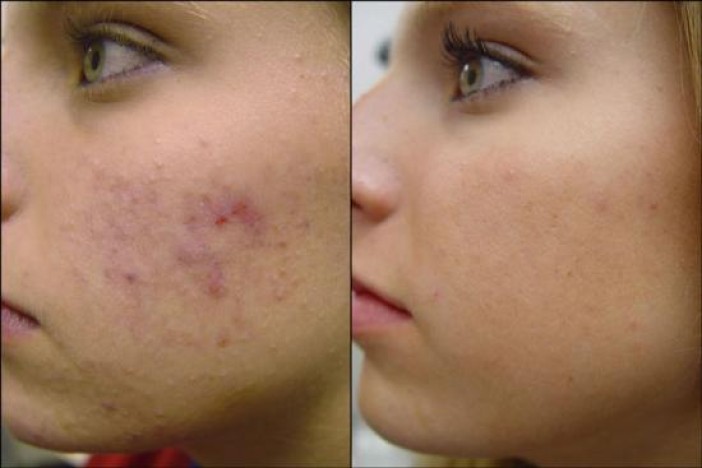 Acne Scar Removal Before and After