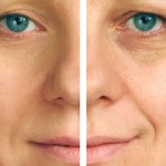 image of effect of Microdermabrasion