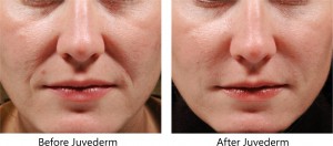 before-after_juvederm
