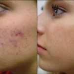 before-and-after-microdermabrasion
