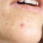 beat-adult-acne