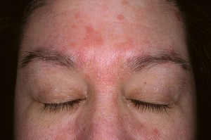 seborrheic dermatitis