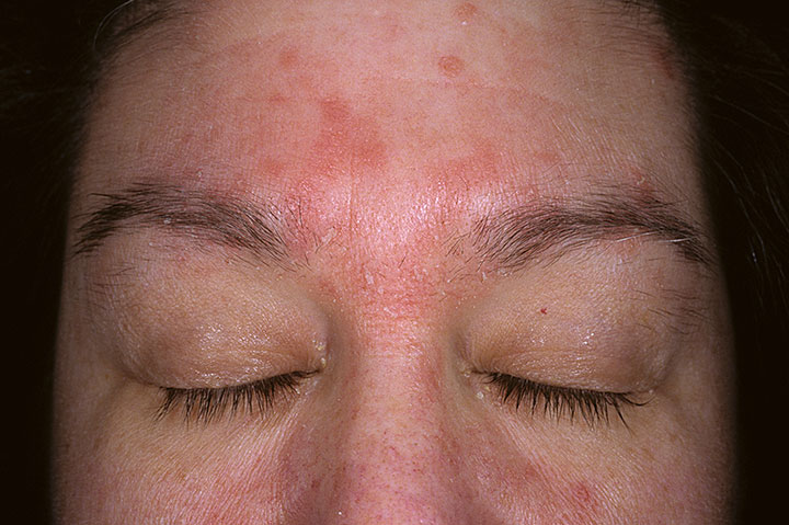 Seborrheic Dermatitis Facial And Waxing Studio